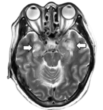 corona encephalitis clipped rev 1