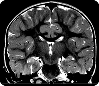 Could MRI and EEG predict risk of epilepsy following febrile seizures- FEBSTAT study suggests