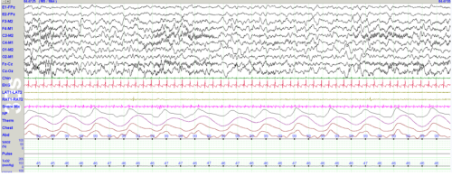 Sleep spindles in a 3-month-old infant. Source: Grigg-Damberger MM. (2012) J Clin Sleep Med, 8(3), 323-32